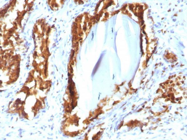 Formalin-fixed, paraffin-embedded human Prostate Carcinoma stained with PSAP Mouse Recombinant Monoclonal Antibody (rACPP/1338).