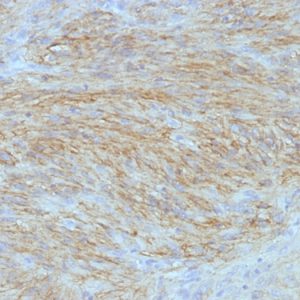 Formalin-fixed, paraffin-embedded human GIST stained with DOG1 Monoclonal Antibody (SPM580).