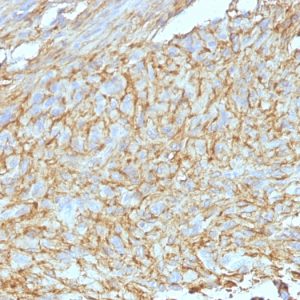 Formalin-fixed, paraffin-embedded human GIST stained with DOG-1 Monoclonal Antibody (DG1/447 + DOG1.1).