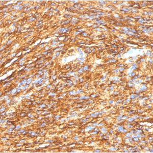 Formalin-fixed, paraffin-embedded human GIST stained with DOG-1 Mouse Monoclonal Antibody (DG1/1484).