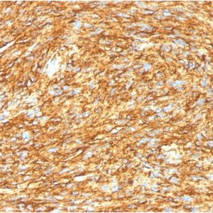 Formalin-fixed, paraffin-embedded human GIST stained with DOG-1 Mouse Monoclonal Antibody (DG1/1485).