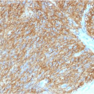 Formalin-fixed, paraffin-embedded human GIST stained with DOG-1 Mouse Monoclonal Antibody (DG1/1486).