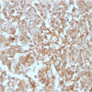 Formalin-fixed, paraffin-embedded human GIST stained with DOG-1 Mouse Recombinant Monoclonal Antibody (rDG1/447). HIER: Tris/EDTA, pH9.0, 45min. 2: HRP-polymer, 30min. DAB, 5min.