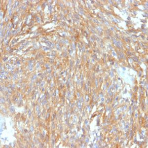 Formalin-fixed, paraffin-embedded human GIST stained with DOG-1 Rabbit Recombinant Monoclonal Antibody (DG1/2564R).