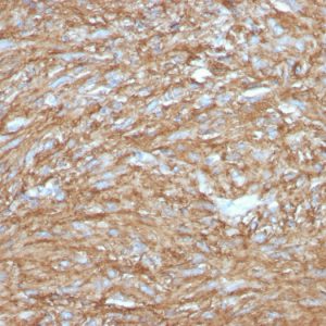 Formalin-fixed, paraffin-embedded human GIST stained with DOG-1 Rabbit Recombinant Monoclonal Antibody (DG1/2831R).