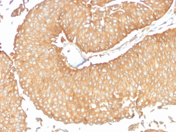 Formalin-fixed, paraffin-embedded human Ovarian Carcinoma stained with Calcineurin A Mouse Monoclonal Antibody (CALNA/2353).