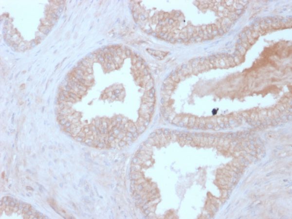 Formalin-fixed, paraffin-embedded human Prostate Carcinoma stained with Calcineurin B Mouse Monoclonal Antibody (CALNB/2342).