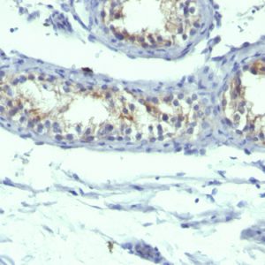 Formalin-fixed, paraffin-embedded human Testicular Carcinoma stained with Prolactin Receptor Monoclonal Antibody (B6.2 + PRLR742).