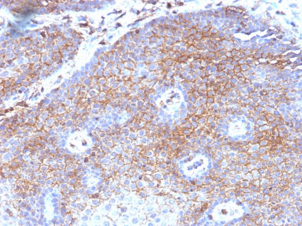 Formalin-fixed, paraffin-embedded human Cervical Carcinoma stained with Beta-2-Microglobulin Mouse Monoclonal Antibody (B2M/1118)