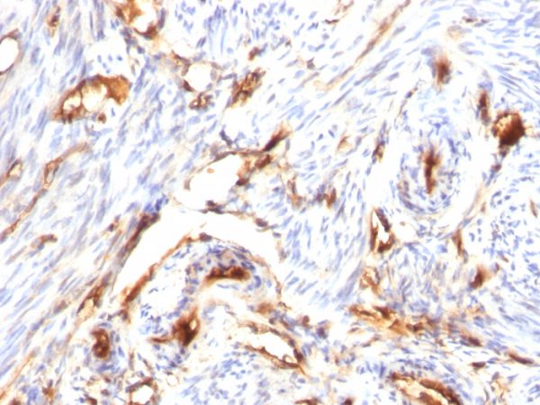 Formalin-fixed, paraffin-embedded human Endometrial Carcinoma stained with Beta-2-Microglobulin Mouse Monoclonal Antibody (B/1118)