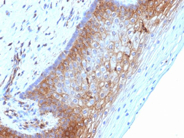 Formalin-fixed, paraffin-embedded human Cervical Ca stained with Beta-2-Microglobulin Mouse Monoclonal Antibody (B2M/1118)