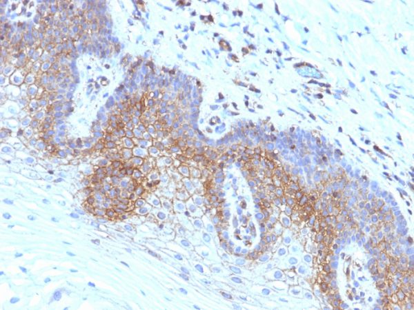 Formalin-fixed, paraffin-embedded human Cervical Carcinoma stained with Beta-2-Microglobulin Monoclonal Antibody (SPM617)