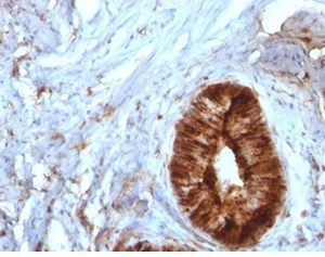 Formalin-fixed, paraffin-embedded human cervical carcinoma stained with Beta-2-Microglobulin Mouse Monoclonal Antibody (B2M/961).