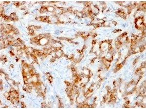 Formalin-fixed, paraffin-embedded human Lung Carcinoma stained with Beta-2-Microglobulin Mouse Recombinant Monoclonal Antibody (rB2M/961).