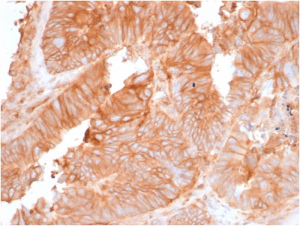 Formalin-fixed, paraffin-embedded human Colon Carcinoma stained with Beta-2-Microglobulin Mouse Recombinant Monoclonal Antibody (rB/961).