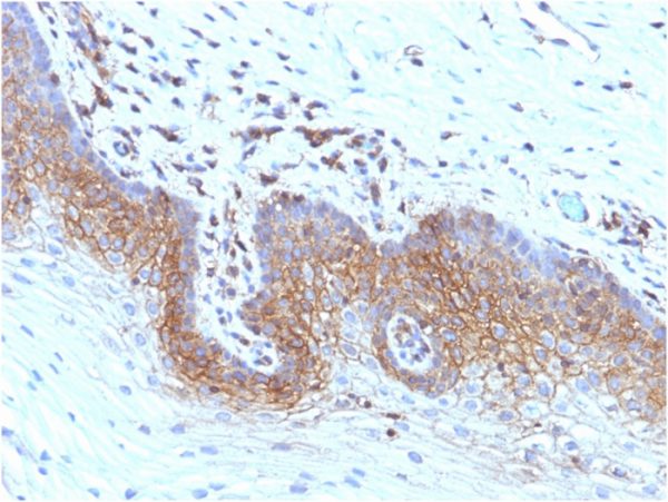 Formalin-fixed, paraffin-embedded human Cervical Carcinoma stained with Beta-2-Microglobulin Mouse Recombinant Monoclonal Antibody (rB2M/961).