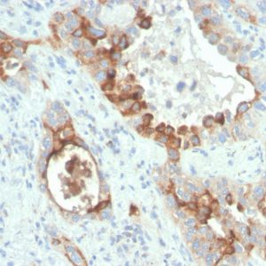 Formalin-fixed, paraffin-embedded human colon carcinoma stained with PMEPA1 Recombinant Mouse Monoclonal (rPMEPA1/6422).