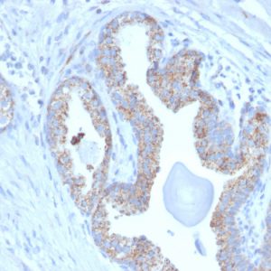 Formalin-fixed, paraffin-embedded human Prostate Carcinoma stained with PMEPA1 Mouse Monoclonal Antibody (PMEPA1/2697).