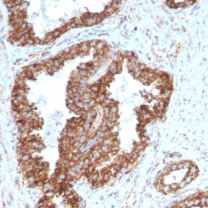 Formalin-fixed, paraffin-embedded human Prostate Carcinoma stained with PMEPA1 Mouse Monoclonal Antibody (PMEPA1/2698).