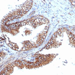 Formalin-fixed, paraffin-embedded human prostate carcinoma stained with PMEPA1 Recombinant Rabbit Monoclonal Antibody (PMEPA1/6421R).