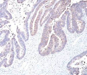 Formalin-fixed, paraffin-embedded human colon carcinoma stained with COX-2 Mouse Monoclonal Antibody (COX2/2377).