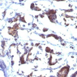 Formalin-fixed, paraffin-embedded human Gastric Carcinoma stained with ZFYVE28 Mouse Monoclonal Antibody (LST2/2426)