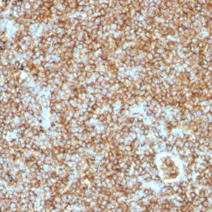 Formalin-fixed, paraffin-embedded human Lymphoma stained with CD45RB Monoclonal Antibody (PTPRC/1147).