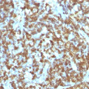 Formalin-fixed, paraffin-embedded human Lymphoma stained with CD45RO Monoclonal Antibody (SPM125).