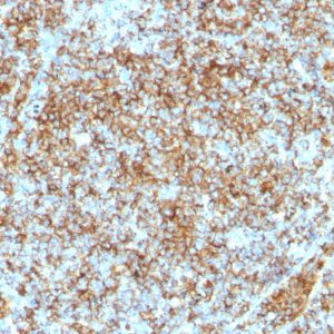 Formalin-fixed, paraffin-embedded human Lymphoma stained with CD45RB Monoclonal Antibody (SPM569).