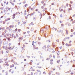 Formalin-fixed, paraffin-embedded human Hodgkin&apos;s Lymphoma stained with Bax Mouse Monoclonal Antibody (2D2).