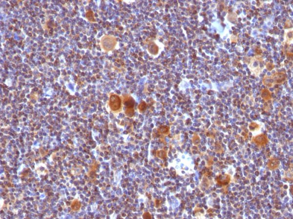 Formalin-fixed, paraffin-embedded human Hodgkin&apos;s Lymphoma stained with Bax Monoclonal Antibody (Clone SPM33).