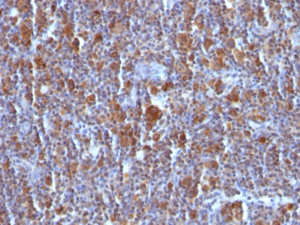 Formalin-fixed, paraffin-embedded Hodgkin&apos;s Lymphoma stained with BAX Mouse Monoclonal Antibody (BAX/962).