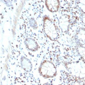 Formalin-fixed, paraffin-embedded human Colon Carcinoma stained with RAD51 Mouse Monoclonal Antibody (RAD51/2702).