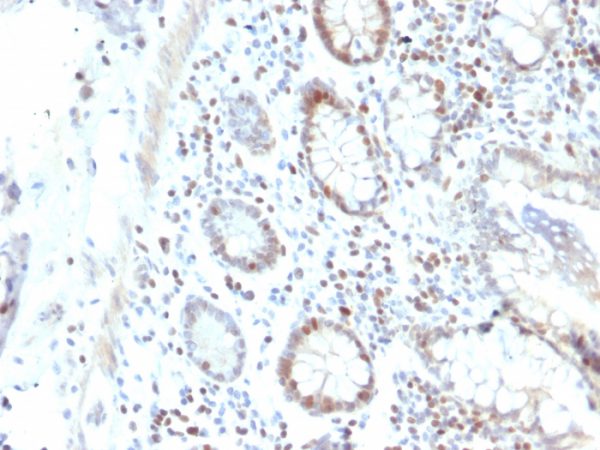 Formalin-fixed, paraffin-embedded human Colon Carcinoma stained with RAD51 Mouse Monoclonal Antibody (RAD51/2702).