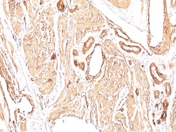 Formalin-fixed, paraffin-embedded human Leiomyosarcoma stained with Smooth Muscle Actin Mouse Monoclonal Antibody (1A4).