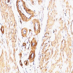 Formalin-fixed, paraffin-embedded human Leiomyosarcoma stained with Smooth Muscle Actin Mouse Monoclonal Antibody (SPM332).