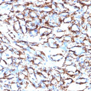 Formalin-fixed, paraffin-embedded human Angiosarcoma stained with Smooth Muscle Actin Monoclonal Antibody (ACTA2/791).