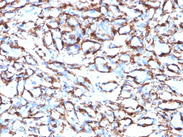 Formalin-fixed, paraffin-embedded human Angiosarcoma stained with Smooth Muscle Actin Monoclonal Antibody (ACTA2/791).