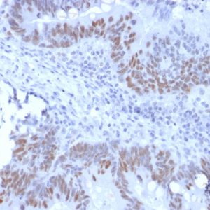 Formalin-fixed, paraffin-embedded human Colon Carcinoma stained with Retinoblastoma Recombinant Rabbit Monoclonal Antibody (RB1/2313R).