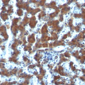 Formalin-fixed, paraffin-embedded human Hepatocellular Carcinoma stained with RBP1 Mouse Monoclonal Antibody (G4E4).