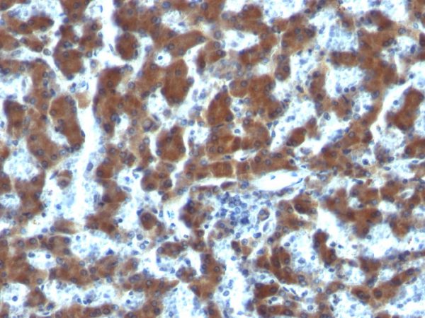 Formalin-fixed, paraffin-embedded human Hepatocellular Carcinoma stained with RBP1 Mouse Monoclonal Antibody (G4E4).