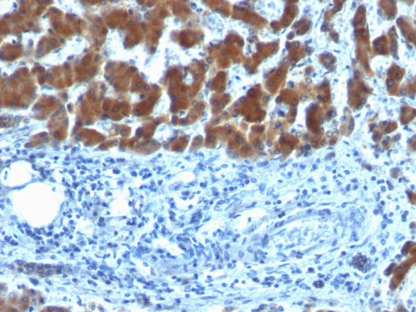 Formalin-fixed, paraffin-embedded human Hepatocellular Carcinoma stained with RBP1 (SPM442)