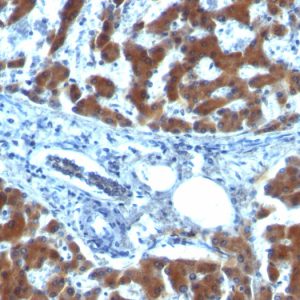Formalin-fixed, paraffin-embedded human Hepatocellular Carcinoma stained with RBP1 (RBP/872)