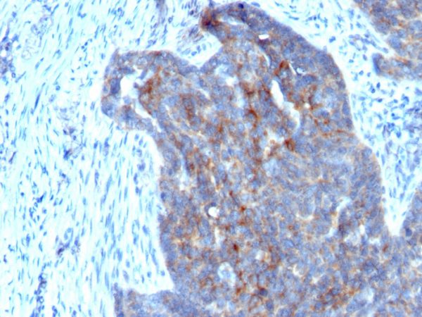 Formalin-fixed, paraffin-embedded human Ovarian Carcinoma stained with RBP1 (RBP/872)