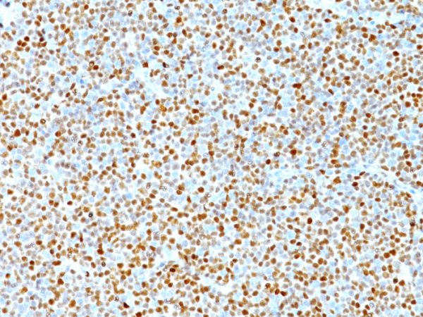 Formalin-fixed, paraffin-embedded human Mantle Cell Lymphoma stained with Cyclin D1 Mouse Monoclonal Antibody (DCS-6).