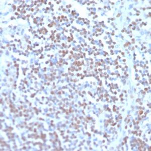 Formalin-fixed, paraffin-embedded human mantle cell lymphoma stained Cyclin D1 Recombinant Mouse Monoclonal Antibody (rCCND1/4752).