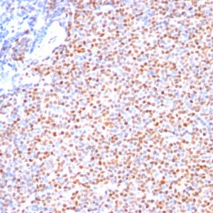 Formalin-fixed, paraffin-embedded human Mantle Cell Lymphoma stained with Cyclin D1 Ab (Clone SPM587).