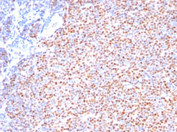 Formalin-fixed, paraffin-embedded human Mantle Cell Lymphoma stained with Cyclin D1 Ab (Clone SPM587).