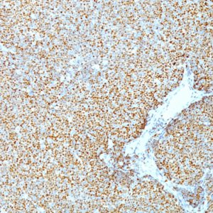 Formalin-fixed, paraffin-embedded human Mantle Cell Lymphoma stained with Cyclin D1 Mouse Monoclonal Antibody (CCND1/809).