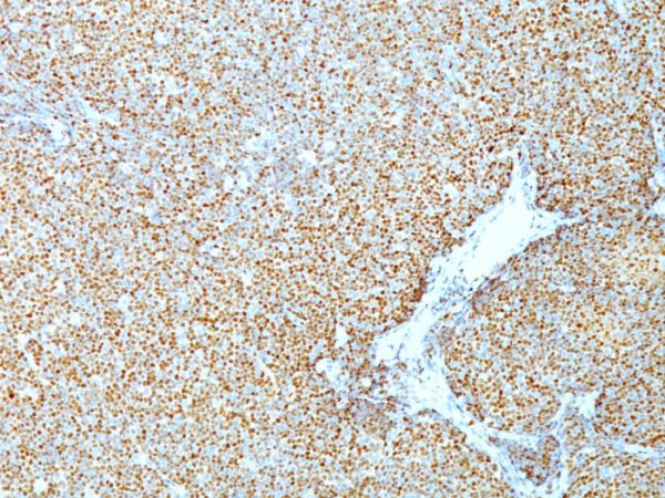 Formalin-fixed, paraffin-embedded human Mantle Cell Lymphoma stained with Cyclin D1 Mouse Monoclonal Antibody (CCND1/809).